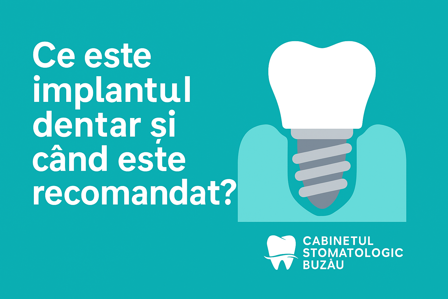 Ce este implantul dentar și când este recomandat?